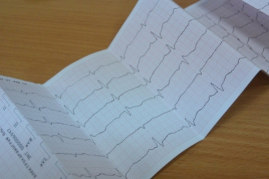 Электрокардиограмма вовремя выявила бессимптомный инфаркт Автор: Наталья Баграновская, ИА EAOmedia